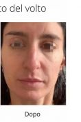 Aumento labbra - Foto del prima - Dott. Andrea Milanese