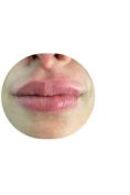 Aumento labbra - Foto del prima - Prof. Sergio Brongo