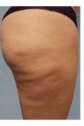 Alternativa alla liposuzione - rimozione del grasso e della cellulite non invasiva - Foto del prima - Dott. Edoardo Garassino M.D