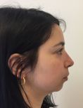 Rinoplastica - Settorinoplastica primaria. Deproiezione e rotazione della punta nasale. Asportazione della spina nasale anteriore ipertrofica.Regolarizzazione del dorso nasale. Armonizzazione del profilo.