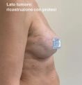 Mastopessi (Lifting del seno) con protesi - Foto del prima