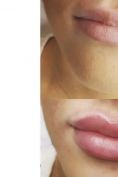 Aumento labbra - Foto del prima - Dott. Savino Bufo