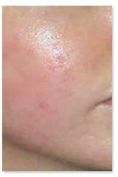 Acne laser, Cicatrici da acne laser - Foto del prima - Polimed