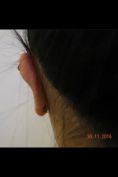 Operazione orecchie (Otoplastica) - Foto del prima - Dott. Marcello Melandri