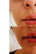 Aumento labbra - Foto del prima - Dott.ssa Silvia Scevola