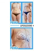 Liposuzione - Foto del prima - Dr. Pietro Loschi