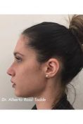 Rinoplastica - Foto del prima - Cliniche Novagenesis - Dott.  Alberto Rossi Todde
