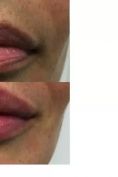 Aumento labbra - Foto del prima - Dott. Luca Grassetti