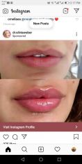 Aumento labbra - Foto del prima - Dott. Hicham Mouallem