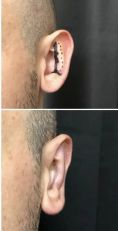 Operazione orecchie (Otoplastica) - Foto del prima - Dott. Andrea Manconi