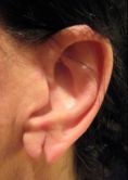 Operazione orecchie (Otoplastica) - Foto del prima - Dott. Fabio Fantozzi