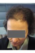 Trapianto capelli - Foto del prima - Prof. Franco Buttafarro