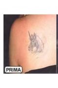 Rimozione tatuaggi - laser - Foto del prima - Medical Center Chirurgia Plastica - Cagliari