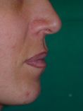 Aumento labbra - Foto del prima - Prof. Franco MIGLIORI