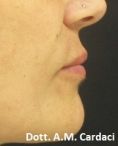 Aumento labbra con Permalip - Foto del prima - Dott. Aurelio M. Cardaci