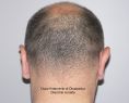 Operazione orecchie (Otoplastica) - Tecnica di Otoplastica:   Incisione dietro l