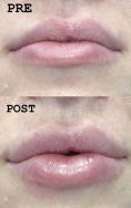 Aumento labbra - Foto del prima - Dott. Alessandro Nube