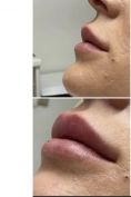 Aumento labbra - Foto del prima - Dott. Luigi Turco