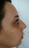 Settoplastica (operazione al setto nasale) - Foto del prima