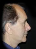 Lifting viso - Foto del prima - Prof. Paolo Morselli