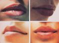 Aumento labbra - Foto del prima - Dott. Guglielmo L. U.A. RUFOLO MD, MRM, FMH