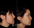 Profiloplastica (Rinoplastica e Mentoplastica) - Malocclusione maxillo-mandibolare eseguita dal Dott. Ikenna Valentine Aboh