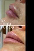 Aumento labbra - Foto del prima - Dott. Luigi Turco
