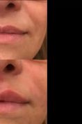 Aumento labbra - Foto del prima - Dr. Massimo Dolcet