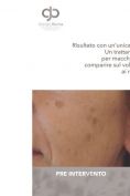 Procedure laser in dermatologia estetica  - Foto del prima - Dott. Giorgio Berna M.D.