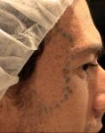 Procedure laser in dermatologia estetica  - Foto del prima - Dott. Fabio Fantozzi