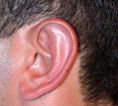 Operazione orecchie (Otoplastica) - Foto del prima - Prof. Vito Contreas