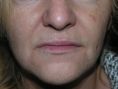 Aumento labbra - Aumento ottenuto mediante il trapianto di tessuto adiposo autologo (Lipofilling)
