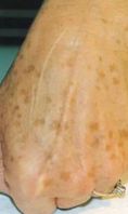 Rimozione tatuaggi - laser - Foto del prima - Dott.ssa Monica De Stefani