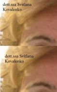 Trattamento delle rughe con botulino - Foto del prima - Dott.ssa Svitlana Kovalenko