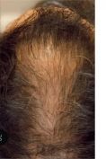 Trapianto capelli - Foto del prima - Dr Uberto Giovannini