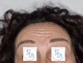 Trattamento delle rughe con botulino - Botox del terzo superiore del viso, rimozione rughe e lifting della coda del sopracciglio.
