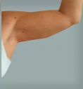Laserlipolisi (liposuzione laser) - Intervento di Liposuzione Laser in sedazione locale alle braccia