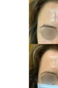 Procedure laser in dermatologia estetica  - Foto del prima