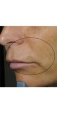 Aumento labbra - Foto del prima - Dott. Giorgio Russo