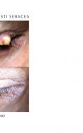 Procedure laser in dermatologia estetica  - Foto del prima - Dott. Francesco Lino