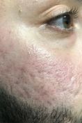 Acne laser, Cicatrici da acne laser - Foto del prima - Dott. Tommaso Savoia Med