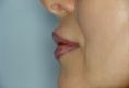 Ingrandimento labbra con grasso (lipofilling) - Foto del prima - Prof. Franco MIGLIORI