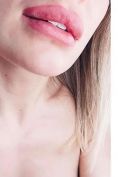 Aumento labbra - Foto del prima - Dott. Tommaso Savoia Med