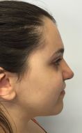 Rinoplastica - Paziente affetta da alterazione di sviluppo del terzo medio ed inferiore del volto. Intervento chirurgico di Le Fort I, BSSO, genioplastica e settorinoplastica funzionale.