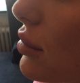 Aumento labbra - Foto del prima - Dott. Guglielmo L. U.A. RUFOLO MD, MRM, FMH