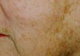 Fotoringiovanimento (IPL) - ringiovanimento della pelle - Foto del prima