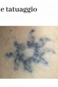 Rimozione tatuaggi - laser - Foto del prima - Dott. Andrea Milanese