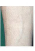 Rimozione tatuaggi - laser - Foto del prima - Dott. Giorgio Russo