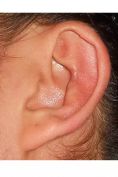 Operazione orecchie (Otoplastica) - Foto del prima - Dott. Massimiliano Calabrò