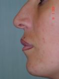 Ingrandimento labbra con grasso (lipofilling) - Foto del prima - Prof. Franco MIGLIORI